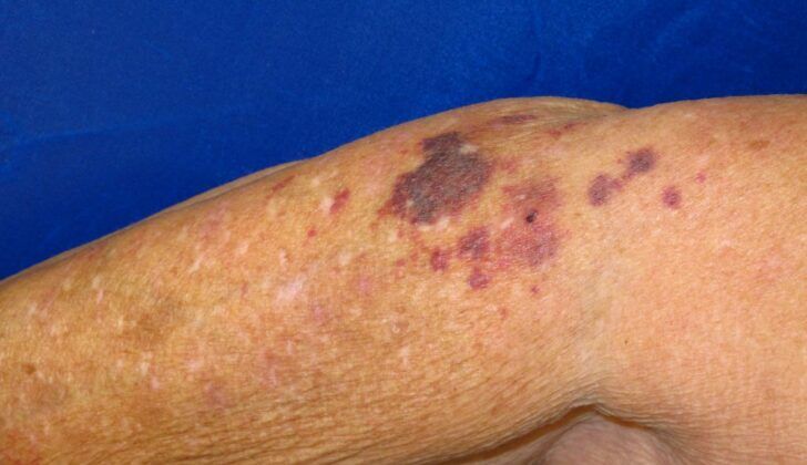 Actinic Purpura