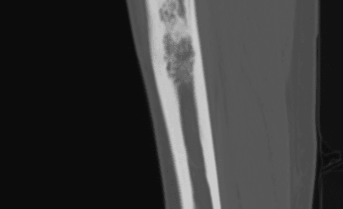 Anterior tibial sclerotic lesion representing a biopsy proven adamantinoma.