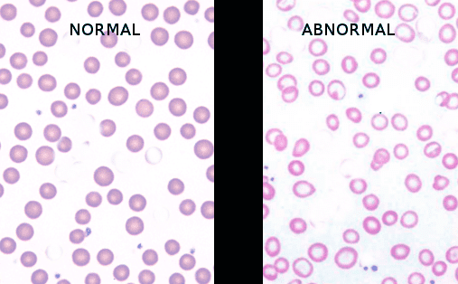 Iron deficiency anemia