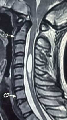 Arnold chiari with syrinx formation