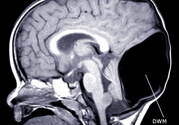 Dandy-Walker Malformation