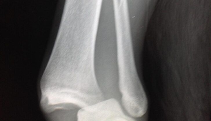 Ankle Fracture Weber C Ankle fracture with dislocation