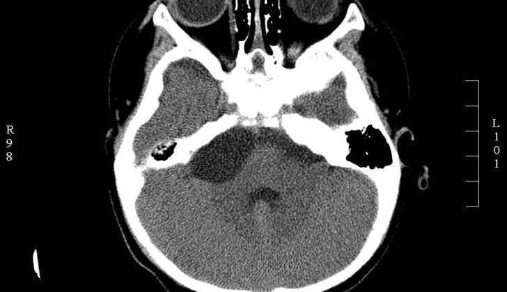 Arachnoid Cyst. Head CT, cerebellopontine angle (CPA) of an arachnoid cyst.