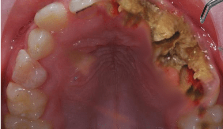 Jaw Osteonecrosis