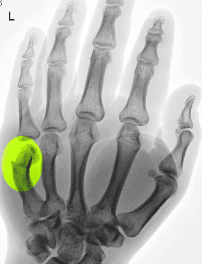 Boxer's Fracture. This x-ray shows a left 5th metacarpal fracture (marked yellow-green).