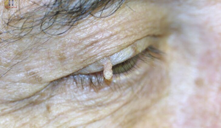 Cutaneous horn or "cornu cutaneum": keratin becomes compacted and looks like a pillar or animal horn, hence the name