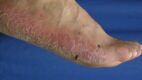 Palmoplantar Psoriasis