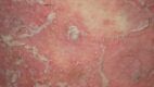 Pustular Psoriasis. Pustular psoriasis is a rare and extreme form of psoriasis characterized by the appearance of sterile pustules, which can take many patterns.