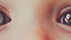 Example of Leukocoria