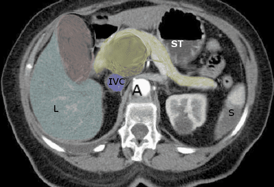 Pancreatic Cancer, Courvoisier Sign. The Courvoisier Sign, characteristically seen in pancreatic cancer, is shown on magnetic resonance imaging.