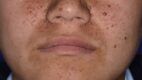 Facial Angiofibromas Observed in Tuberous Sclerosis. Facial angiofibromas are considered one of the most apparent clinical presentations of tuberous sclerosis, an autosomal dominant hamartomatous disorder that affects the skin, kidneys, heart, brain, and lungs.