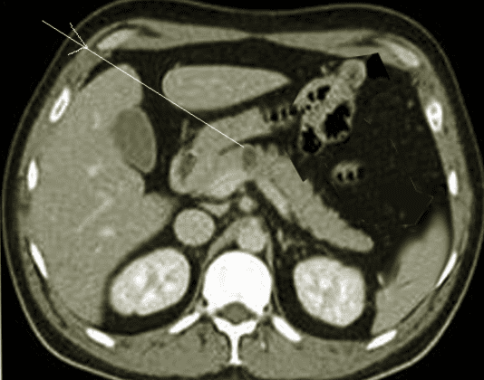 Somatostatinoma
