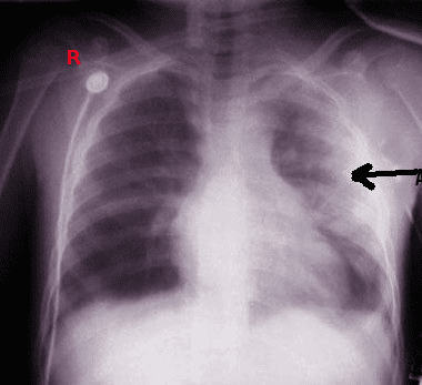 Pulmonary Contusion Radiograph. This image shows a left pulmonary contusion.