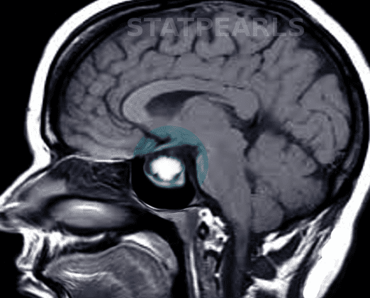 Prolactinoma MRI