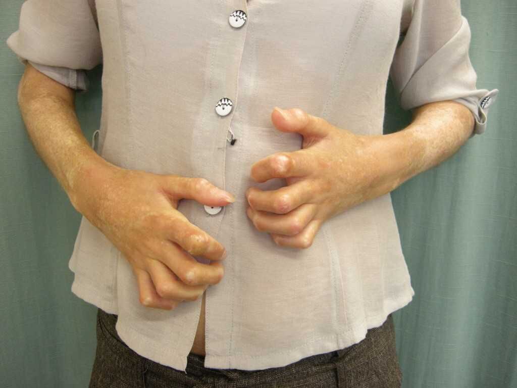 Bilateral Signs of Raynaud Phenomenon in a Patient's Hands. A male patient is exhibiting triphasic color changes in the digits of his hands, indicative of Raynaud Phenomenon.