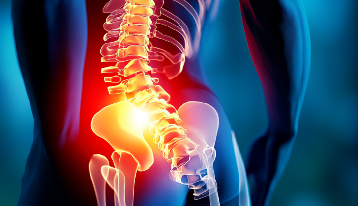 Pudendal neuralgia is a condition characterized by chronic pain in the pelvic region, often caused by compression or irritation of the pudendal nerve.
