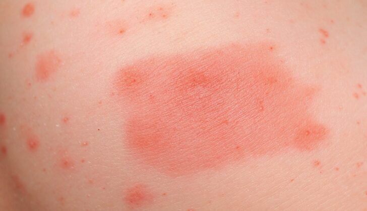 Chronic Urticaria (Chronic Hives)